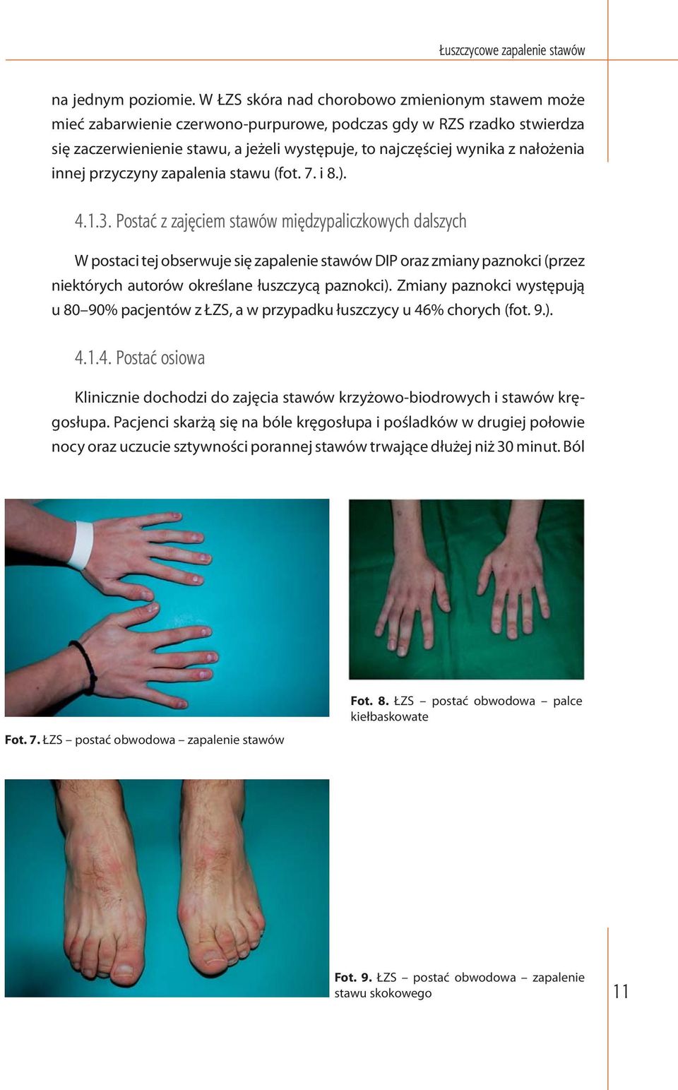 nałożenia innej przyczyny zapalenia stawu (fot. 7. i 8.). 4.1.3.