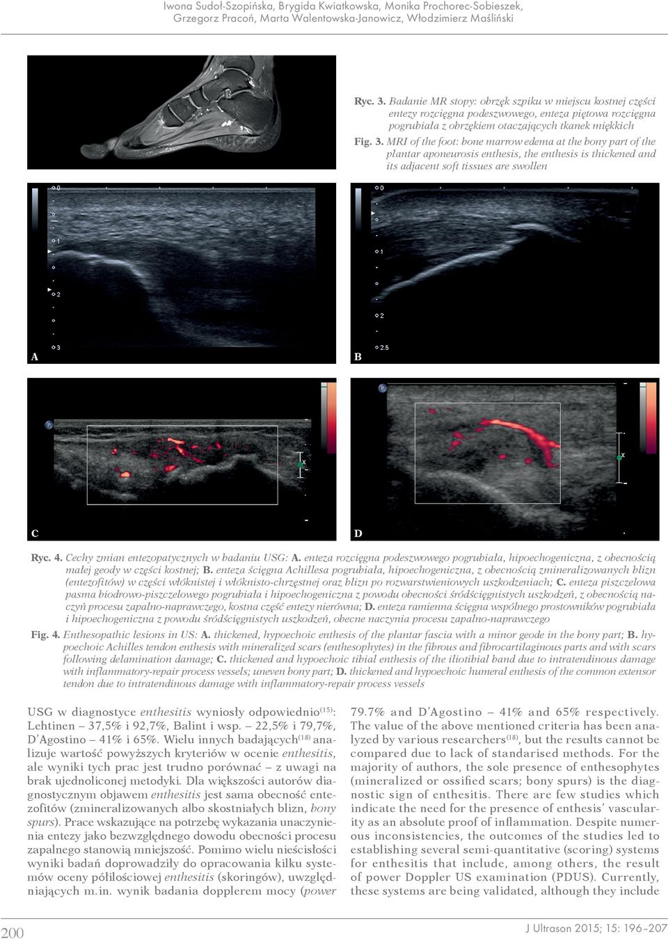 MRI of the foot: bone marrow edema at the bony part of the plantar aponeurosis enthesis, the enthesis is thickened and its adjacent soft tissues are swollen C D Ryc. 4.