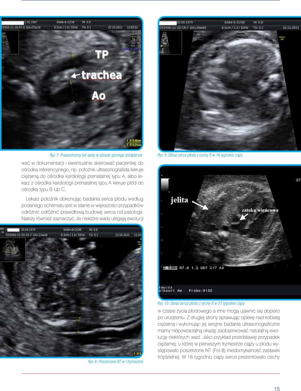 Ryc 9: Obraz serca płodu z ryciny 8 w 16 tygodniu ciąży Lekarz położnik dokonując badania serca płodu według podanego schematu jest w stanie w większości przypadków odróżnić odróżnić prawidłową