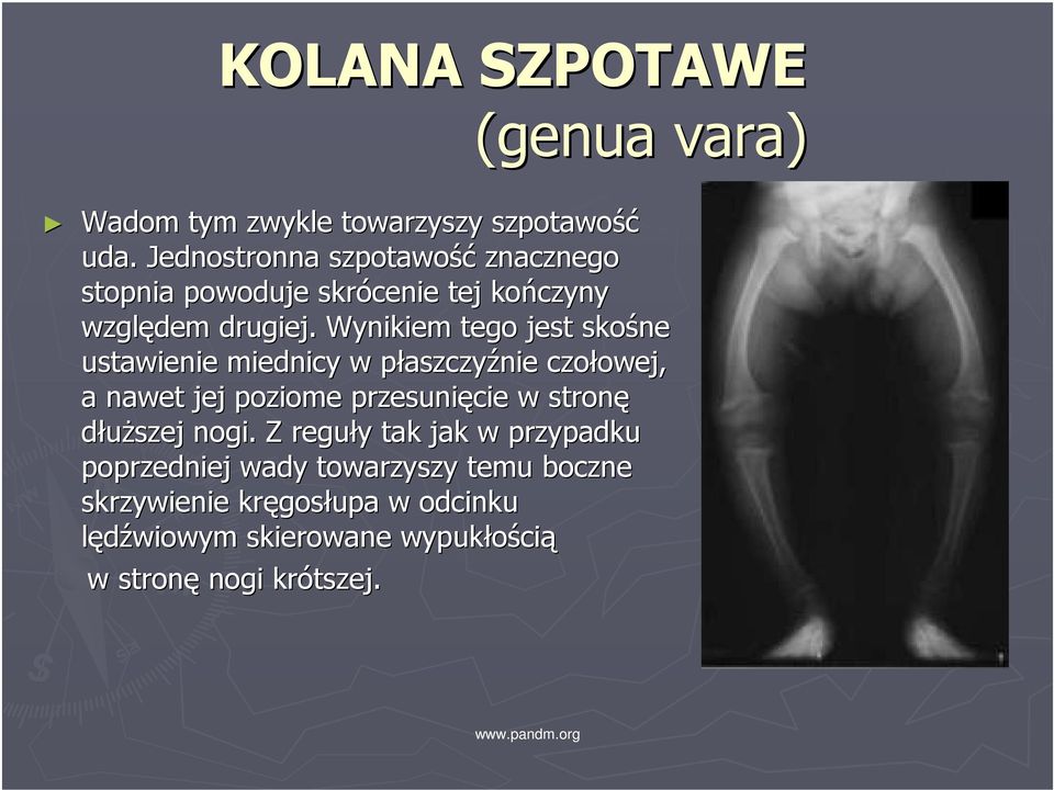 Wynikiem tego jest skośne ustawienie miednicy w płaszczyp aszczyźnie czołowej, owej, a nawet jej poziome przesunięcie