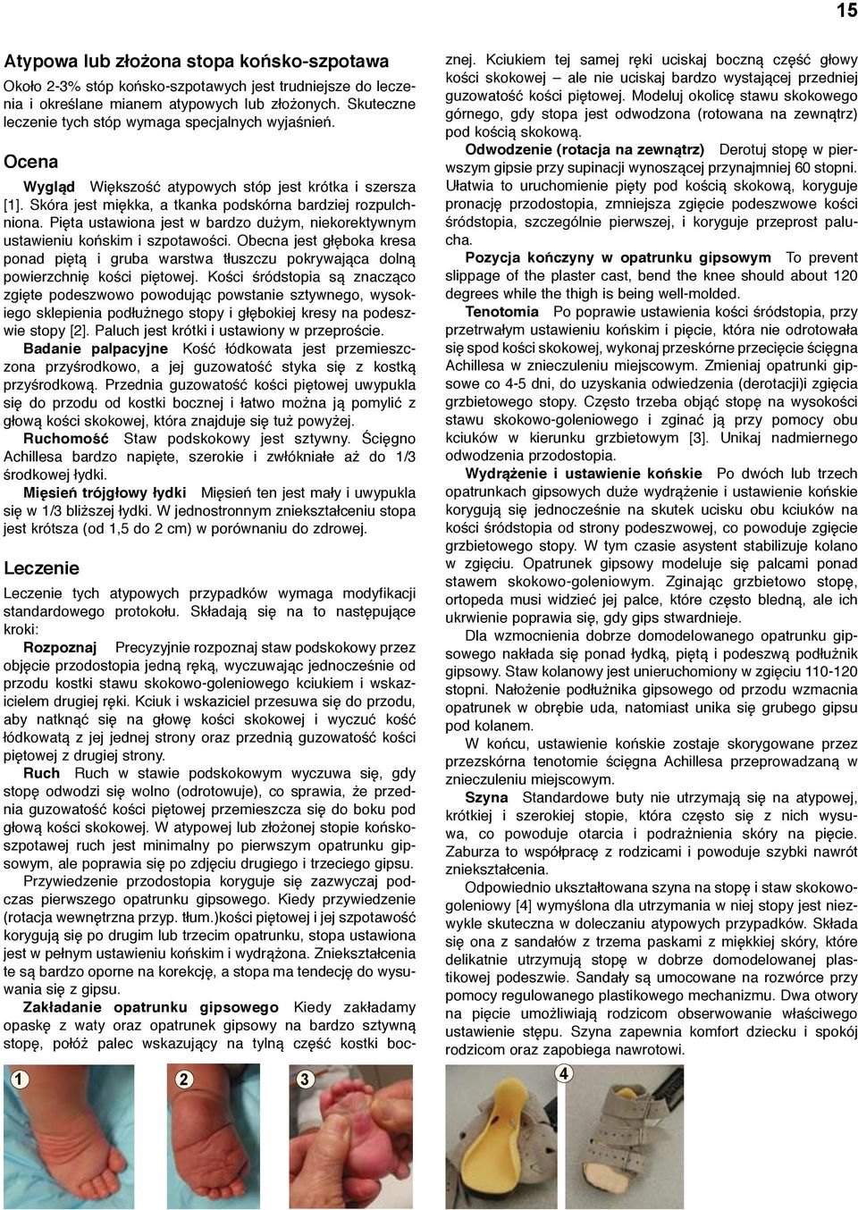 Pięta ustawiona jest w bardzo dużym, niekorektywnym ustawieniu końskim i szpotawości. Obecna jest głęboka kresa ponad piętą i gruba warstwa tłuszczu pokrywająca dolną powierzchnię kości piętowej.