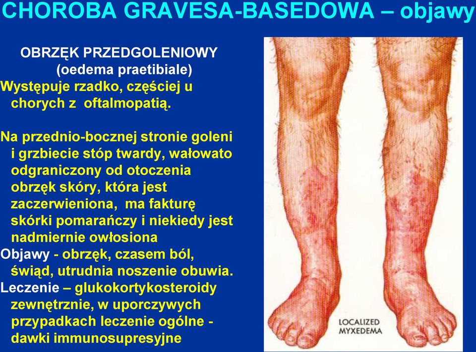 Na przednio-bocznej stronie goleni i grzbiecie stóp twardy, wałowato odgraniczony od otoczenia obrzęk skóry, która jest