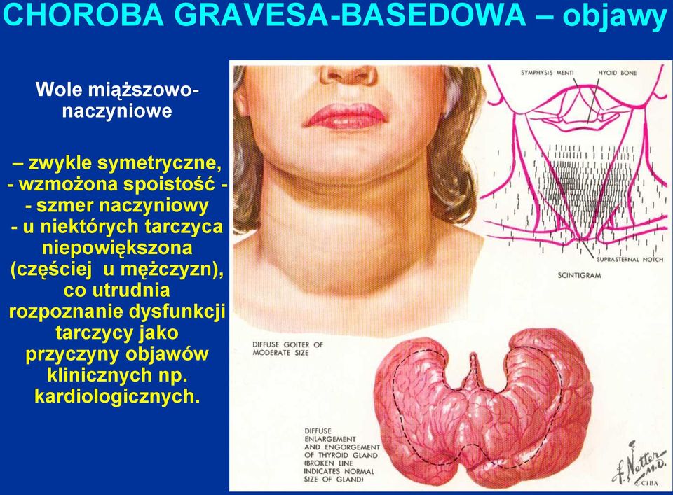 tarczyca niepowiększona (częściej u mężczyzn), co utrudnia rozpoznanie