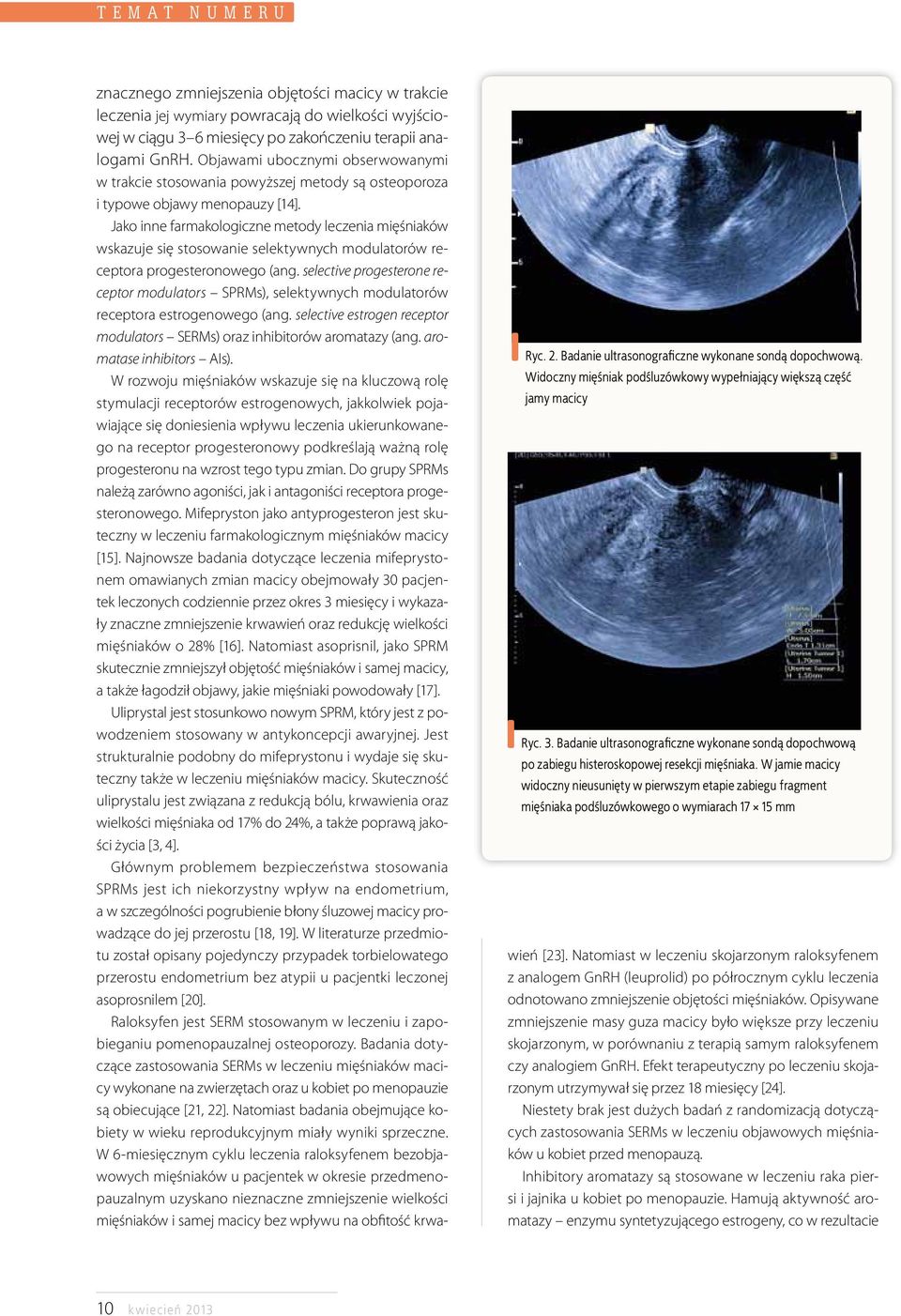 W jamie macicy widoczny nieusunięty w pierwszym etapie zabiegu fragment mięśniaka podśluzówkowego o wymiarach 17 15 mm znacznego zmniejszenia objętości macicy w trakcie leczenia jej wymiary powracają