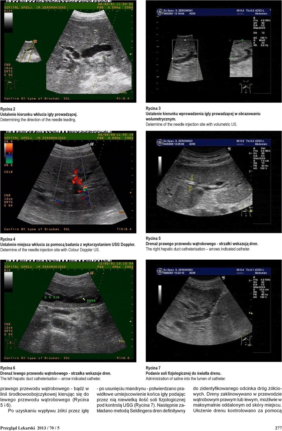 Determine of the needle injection site with Colour Doppler US. Rycina 5 Drenaż prawego przewodu wątrobowego - strzałki wskazują dren. The right hepatic duct catheterisation arrows indicated catheter.