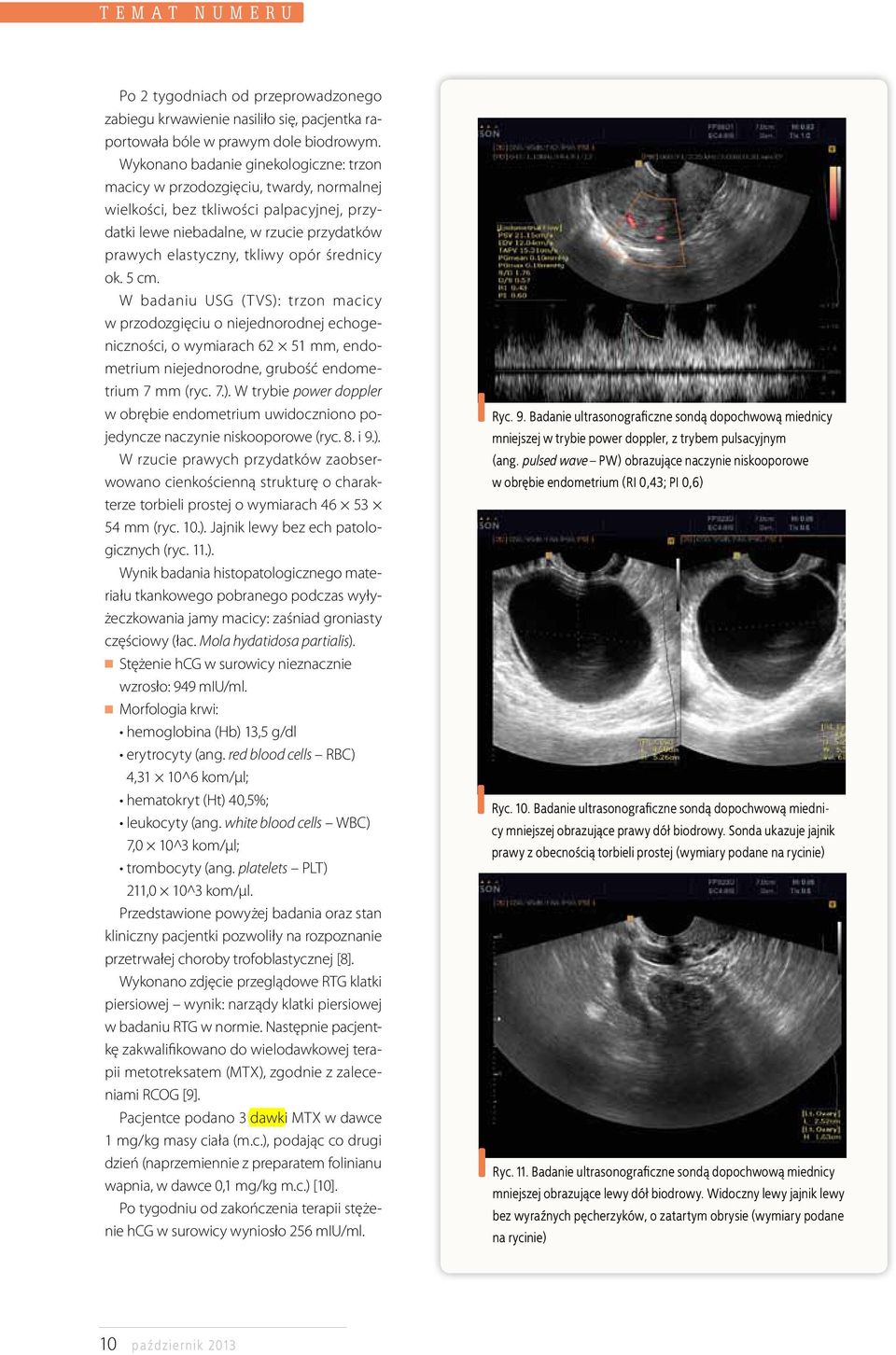średnicy ok. 5 cm. W badaniu USG (TVS): trzon macicy w przodozgięciu o niejednorodnej echogeniczności, o wymiarach 62 51 mm, endometrium niejednorodne, grubość endometrium 7 mm (ryc. 7.). W trybie power doppler w obrębie endometrium uwidoczniono pojedyncze naczynie niskooporowe (ryc.