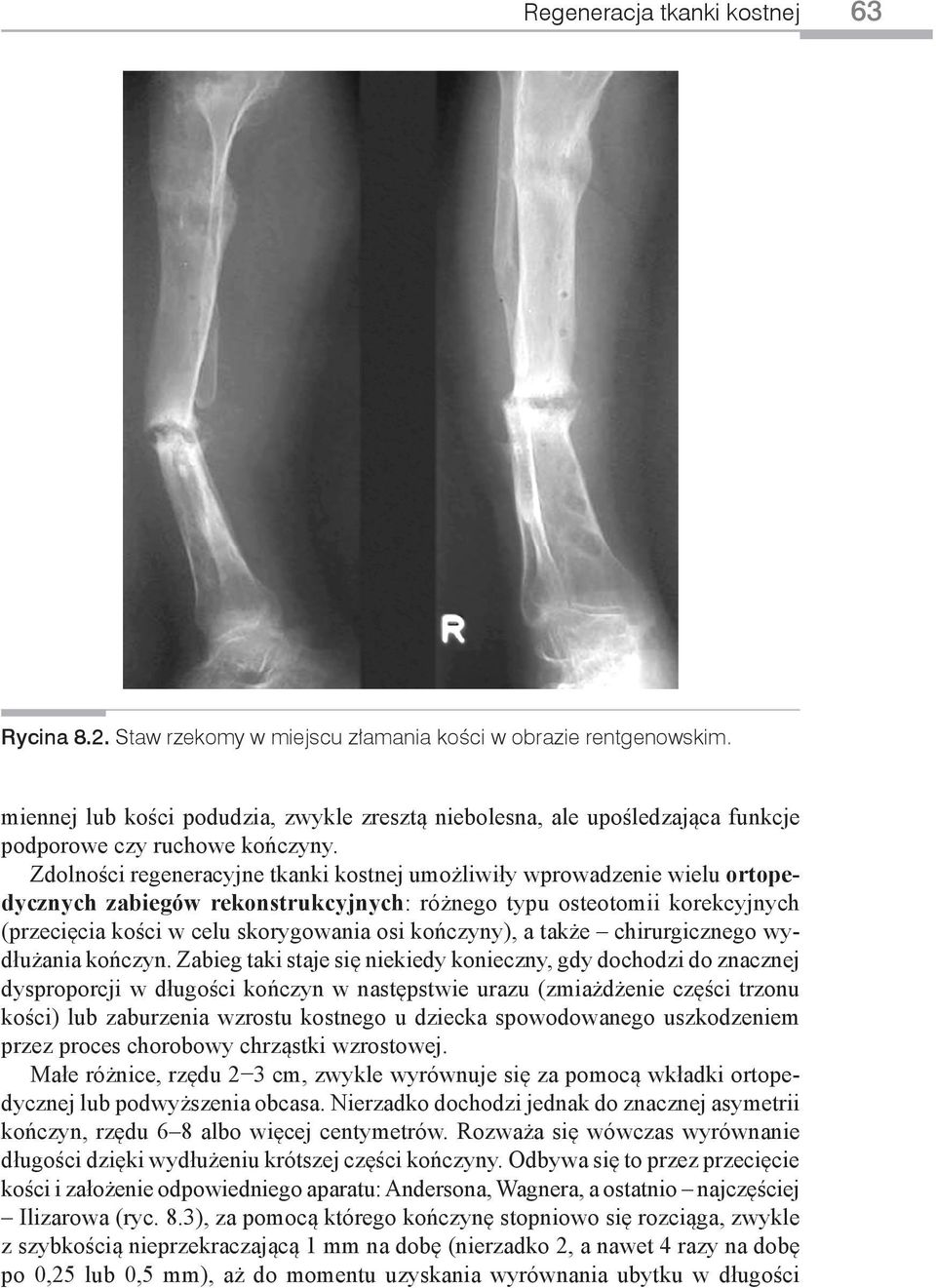 Zdolności regeneracyjne tkanki kostnej umożliwiły wprowadzenie wielu ortopedycznych zabiegów rekonstrukcyjnych: różnego typu osteotomii korekcyjnych (przecięcia kości w celu skorygowania osi