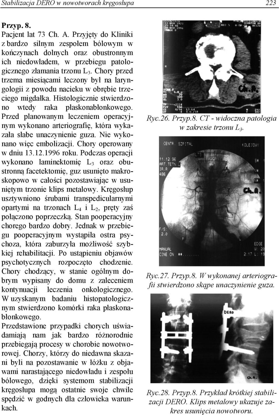 Chory przed trzema miesiącami leczony był na laryngologii z powodu nacieku w obrębie trzeciego migdałka. Histologicznie stwierdzono wtedy raka płaskonabłonkowego.