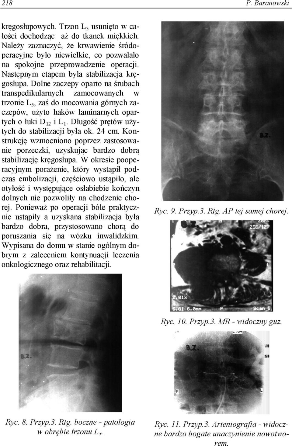 Dolne zaczepy oparto na śrubach transpedikularnych zamocowanych w trzonie L 5, zaś do mocowania górnych zaczepów, użyto haków laminarnych opartych o łuki D 12 i L 1.