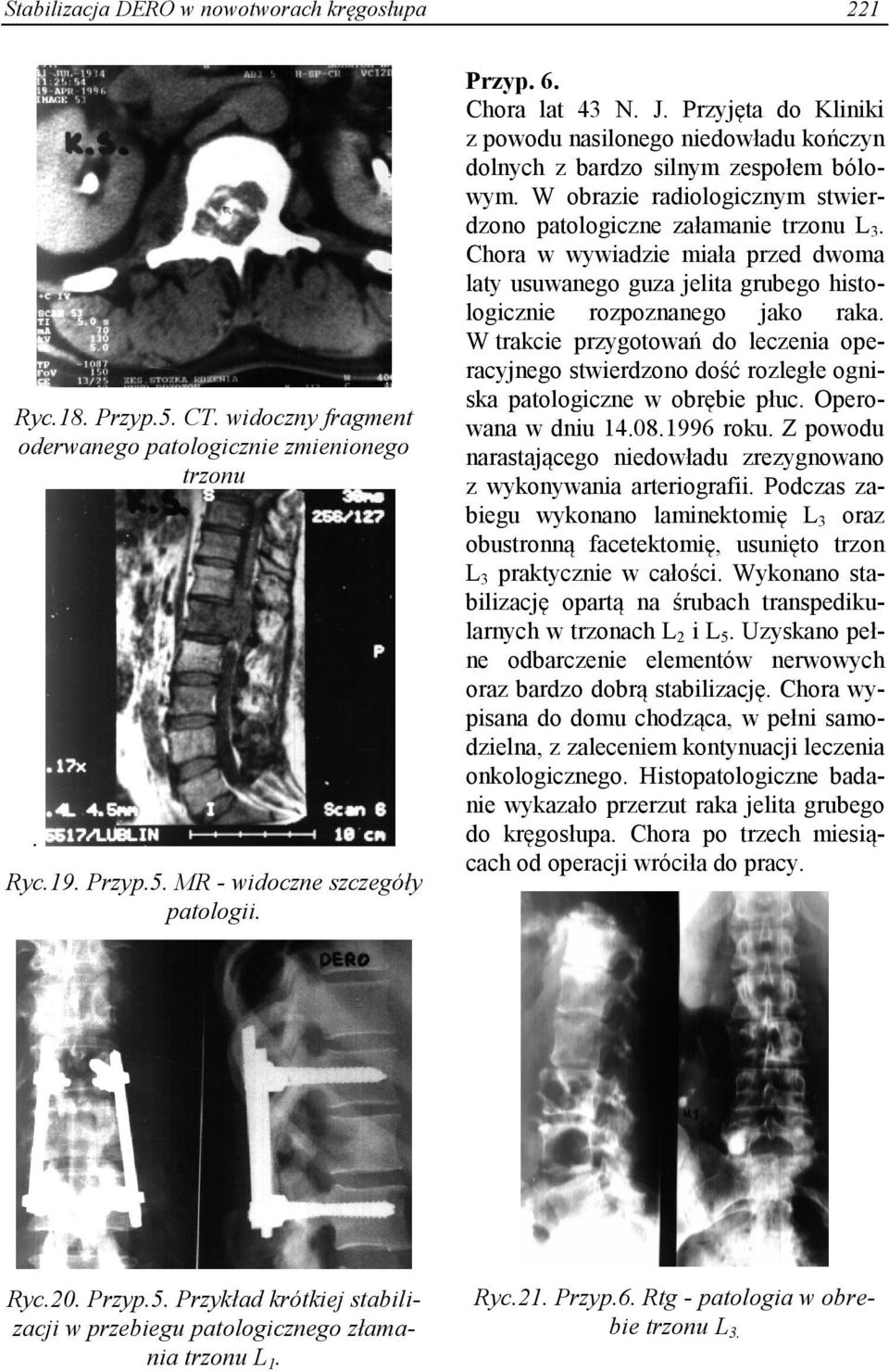 Chora w wywiadzie miała przed dwoma laty usuwanego guza jelita grubego histologicznie rozpoznanego jako raka.