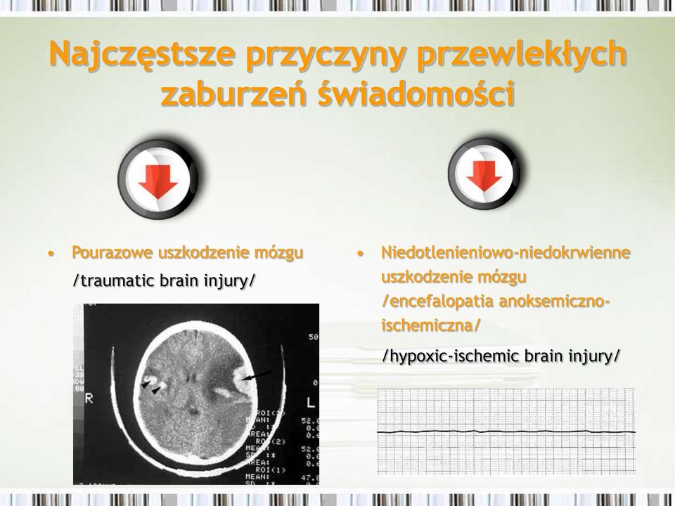 Niedotlenieniowo-niedokrwienne uszkodzenie mózgu