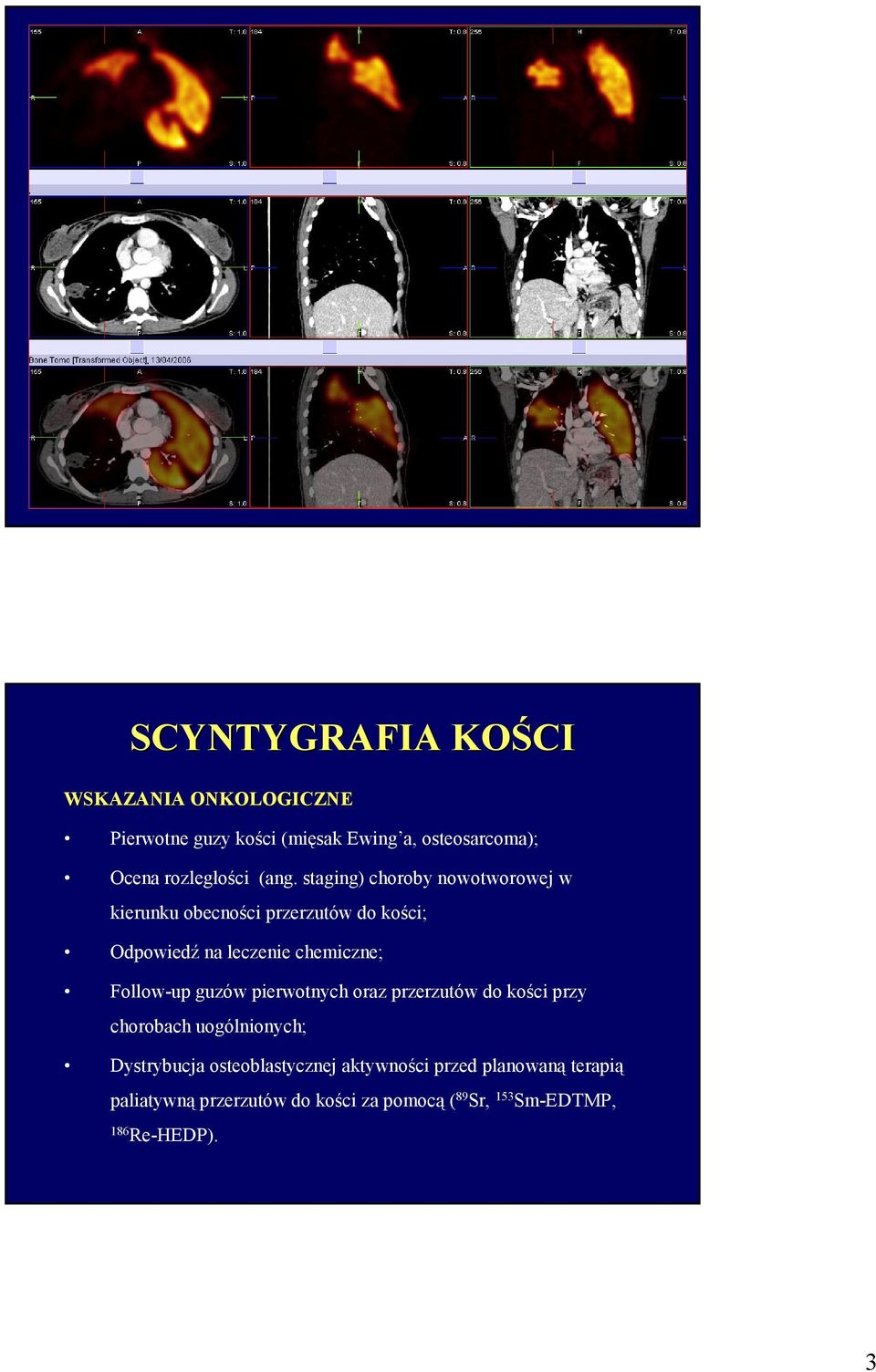 Follow-up guzów pierwotnych oraz przerzutów do kości przy chorobach uogólnionych; Dystrybucja osteoblastycznej