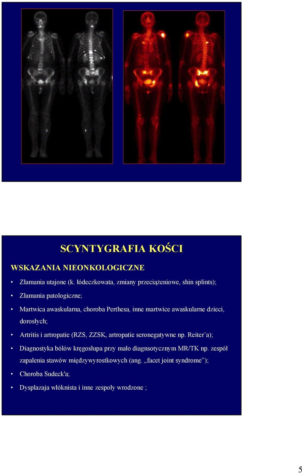 martwice awaskularne dzieci, dorosłych; Artritis i artropatie (RZS, ZZSK, artropatie seronegatywne np.