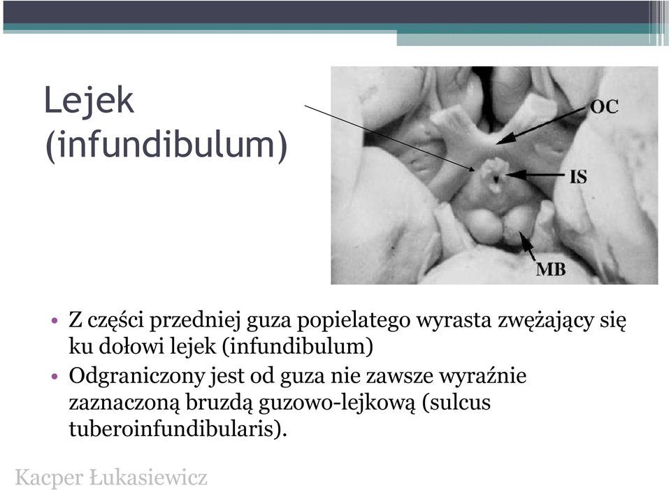 (infundibulum) Odgraniczony jest od guza nie zawsze