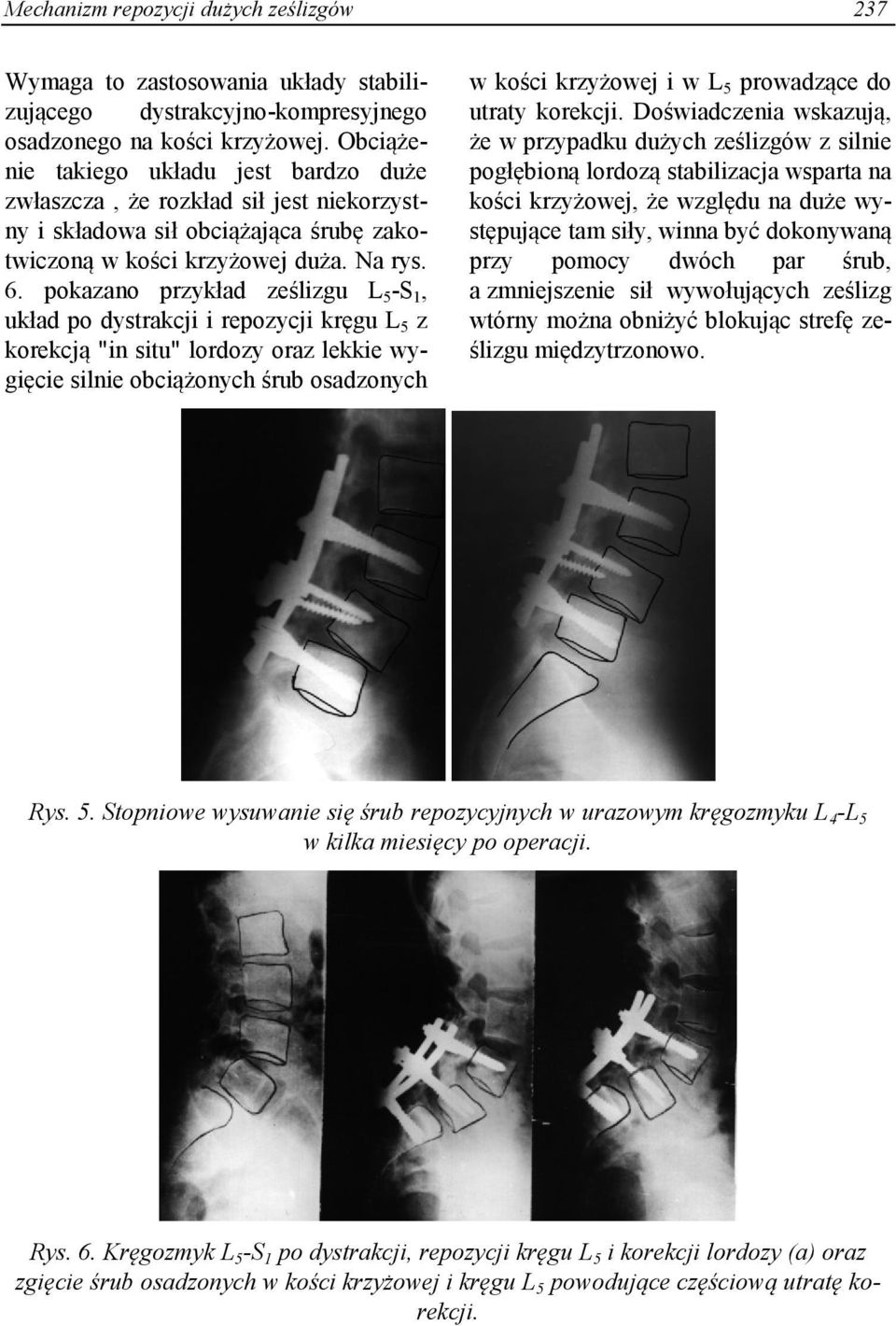 pokazano przykład ześlizgu L 5 -S 1, układ po dystrakcji i repozycji kręgu L 5 z korekcją "in situ" lordozy oraz lekkie wygięcie silnie obciążonych śrub osadzonych w kości krzyżowej i w L 5