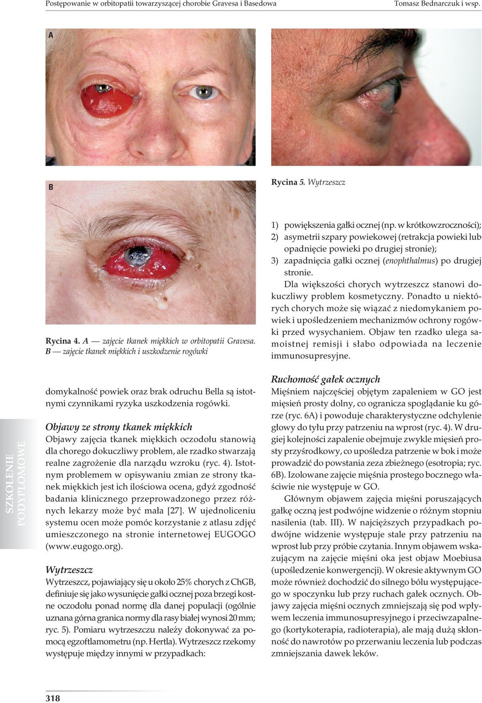 w krótkowzroczności); 2) asymetrii szpary powiekowej (retrakcja powieki lub opadnięcie powieki po drugiej stronie); 3) zapadnięcia gałki ocznej (enophthalmus) po drugiej stronie.