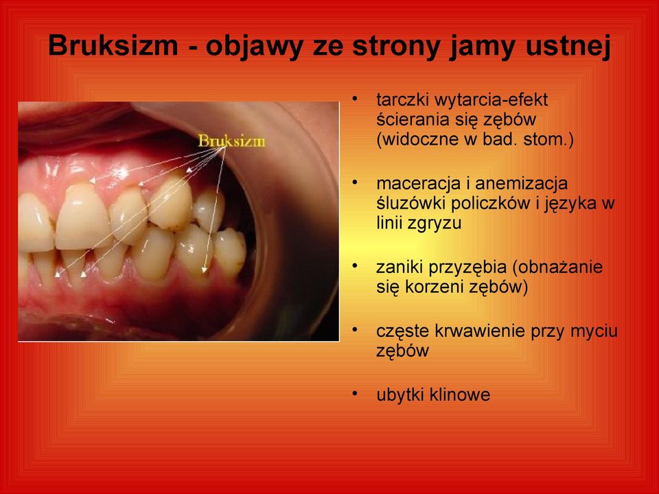 ) maceracja i anemizacja śluzówki policzków i języka w linii zgryzu