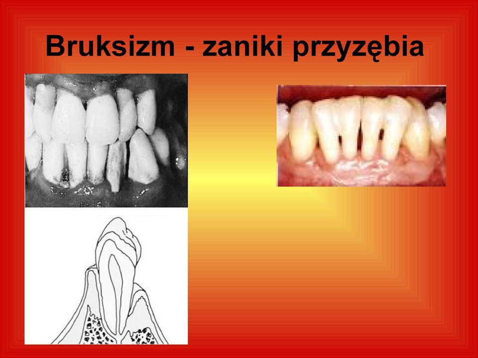 przyzębia