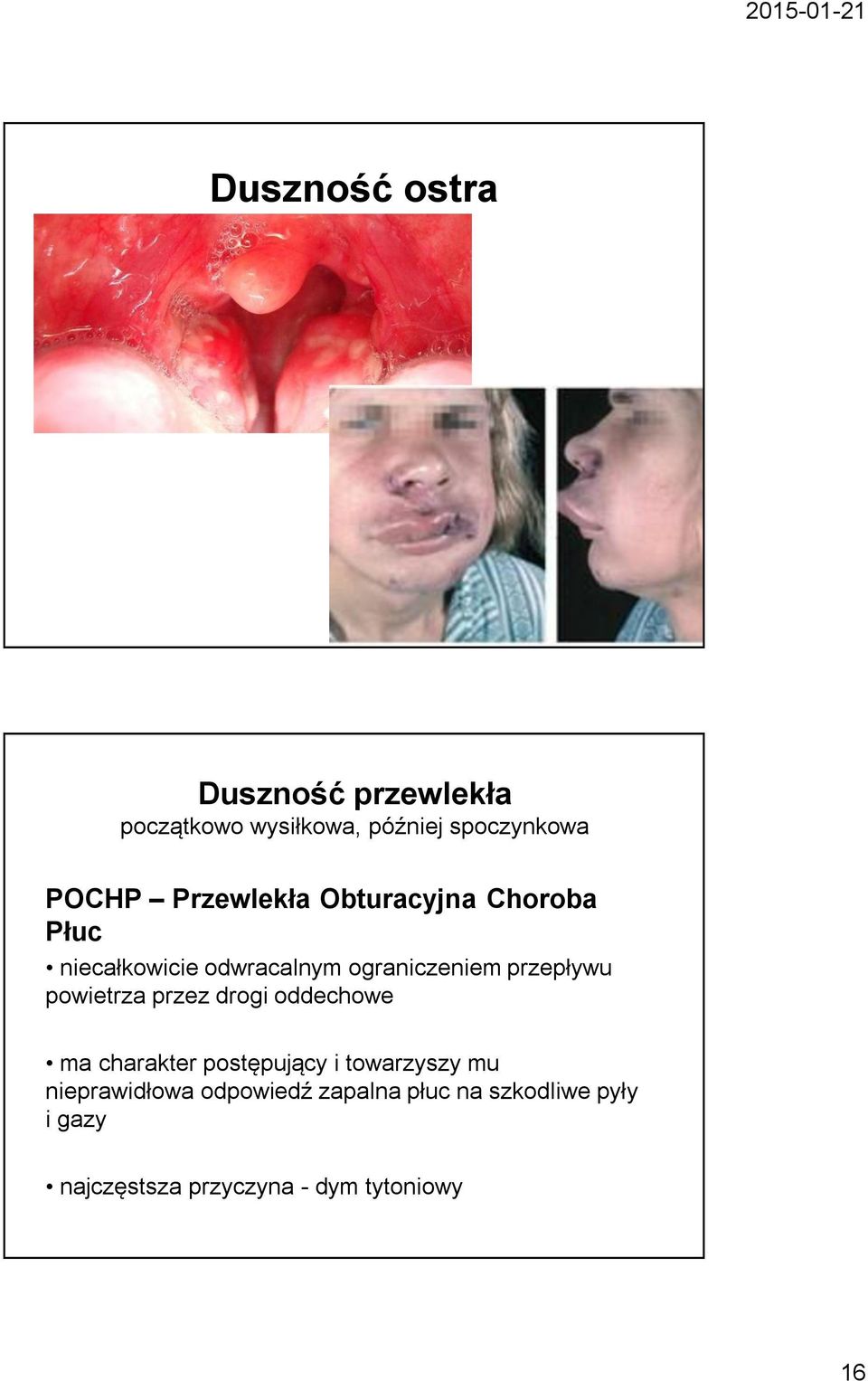 powietrza przez drogi oddechowe ma charakter postępujący i towarzyszy mu