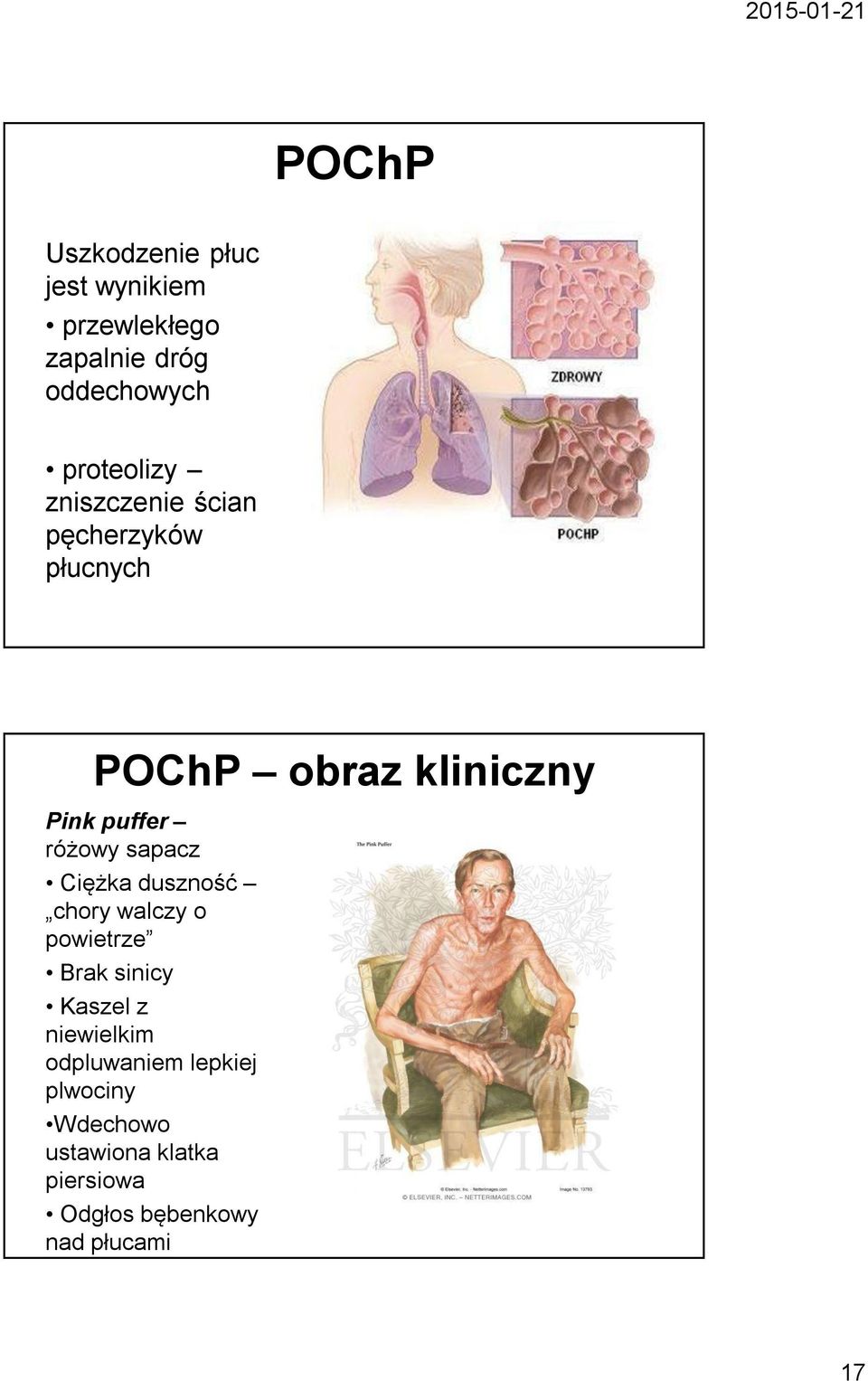 różowy sapacz Ciężka duszność chory walczy o powietrze Brak sinicy Kaszel z