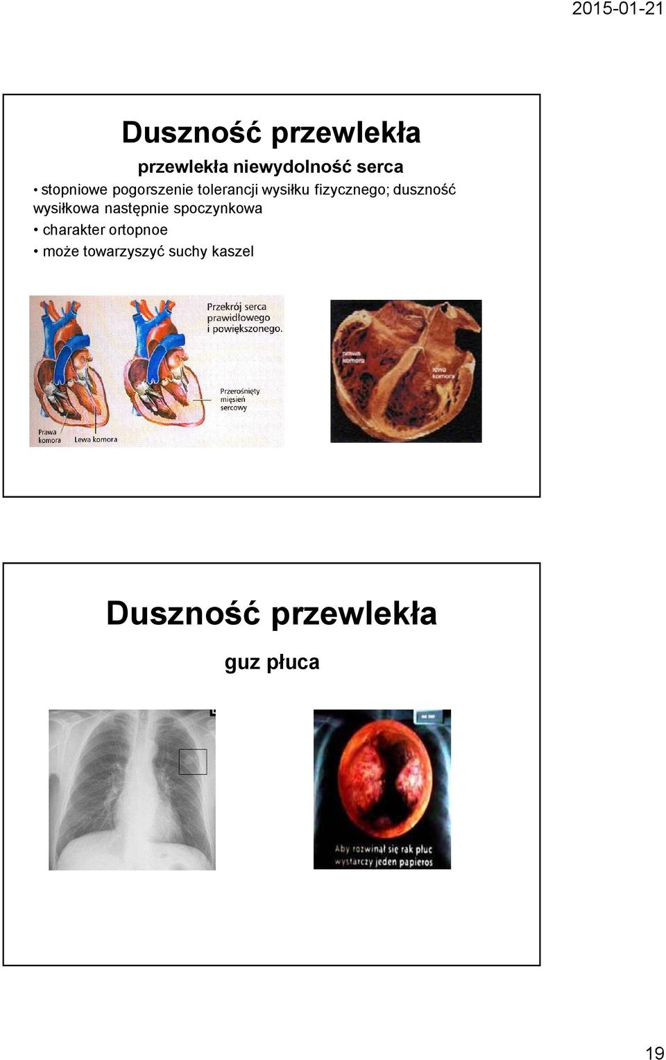 duszność wysiłkowa następnie spoczynkowa charakter