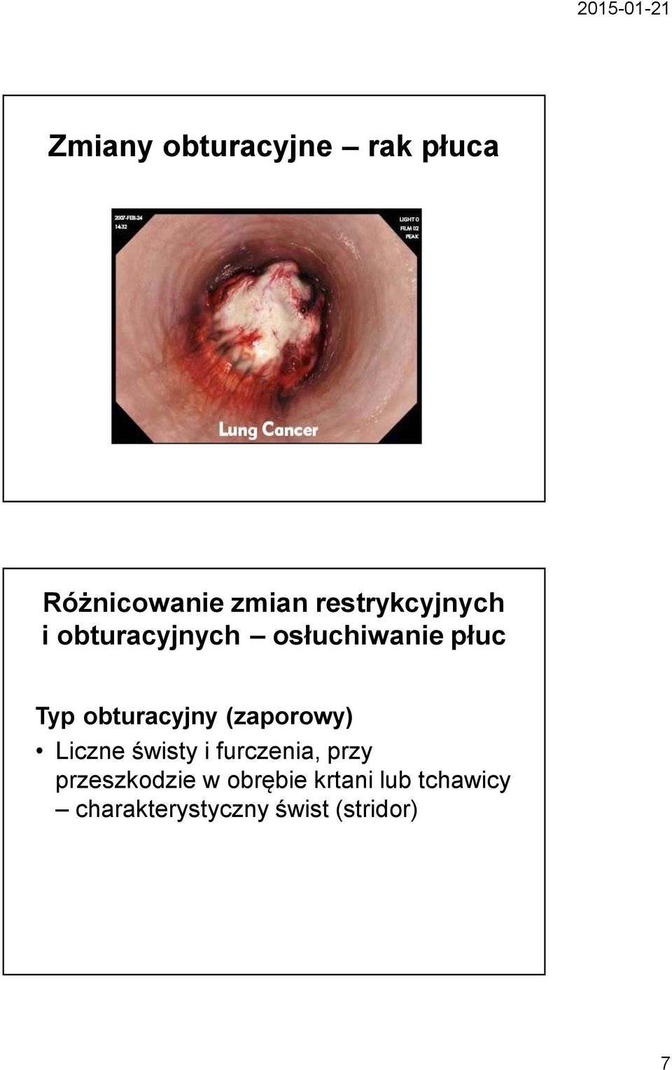 obturacyjny (zaporowy) Liczne świsty i furczenia, przy