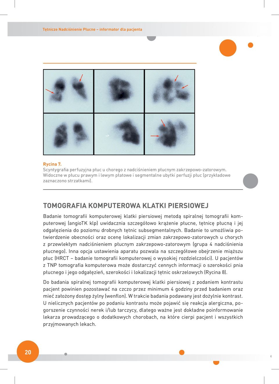 Tomografia komputerowa klatki piersiowej Badanie tomografii komputerowej klatki piersiowej metodą spiralnej tomografii komputerowej (angiotk klp) uwidacznia szczegółowo krążenie płucne, tętnicę