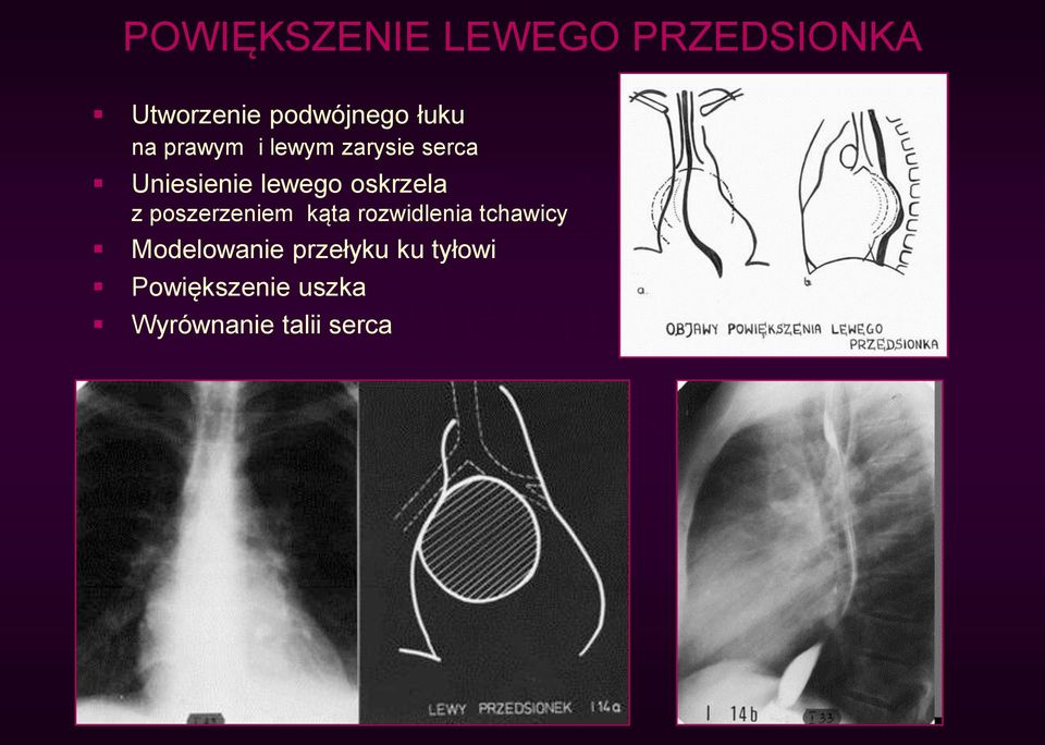 oskrzela z poszerzeniem kąta rozwidlenia tchawicy