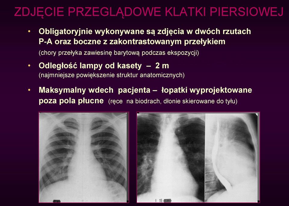 ekspozycji) Odległość lampy od kasety 2 m (najmniejsze powiększenie struktur anatomicznych)