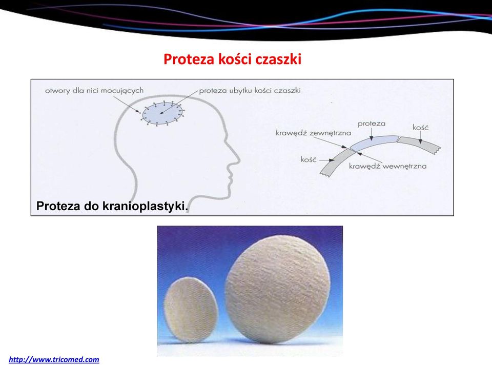 do kranioplastyki.