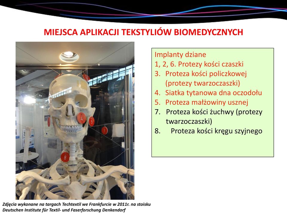 Proteza małżowiny usznej 7. Proteza kości żuchwy (protezy twarzoczaszki) 8.