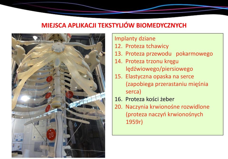 Proteza trzonu kręgu lędźwiowego/piersiowego 15.