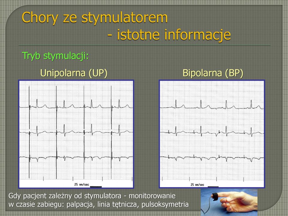 stymulatora - monitorowanie w czasie