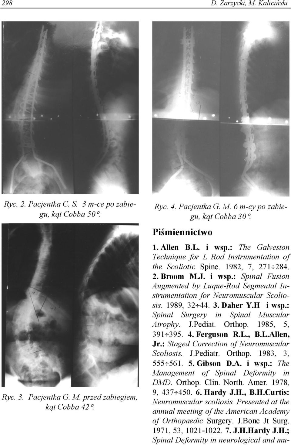 1989, 32 44. 3. Daher Y.H i wsp.: Spinal Surgery in Spinal Muscular Atrophy. J.Pediat. Orthop. 1985, 5, 391 395. 4. Ferguson R.L., B.L.Allen, Jr.: Staged Correction of Neuromuscular Scoliosis. J.Pediatr.