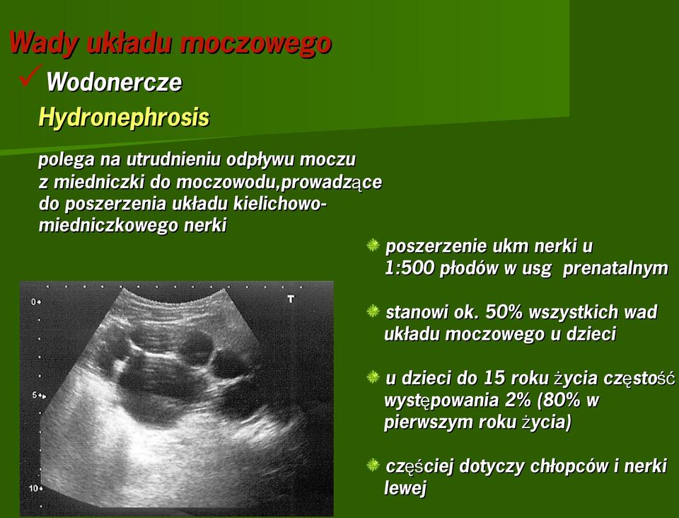 1:500 płodów w usg prenatalnym stanowi ok.
