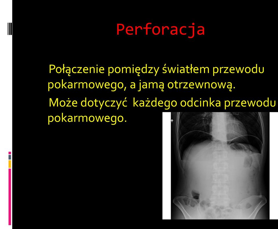 jamą otrzewnową.