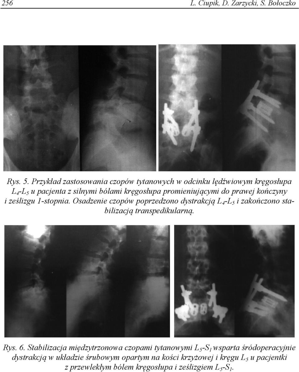 do prawej kończyny i ześlizgu 1-stopnia. Osadzenie czopów poprzedzono dystrakcją L 4 -L 5 i zakończono stabilizacją transpedikularną.