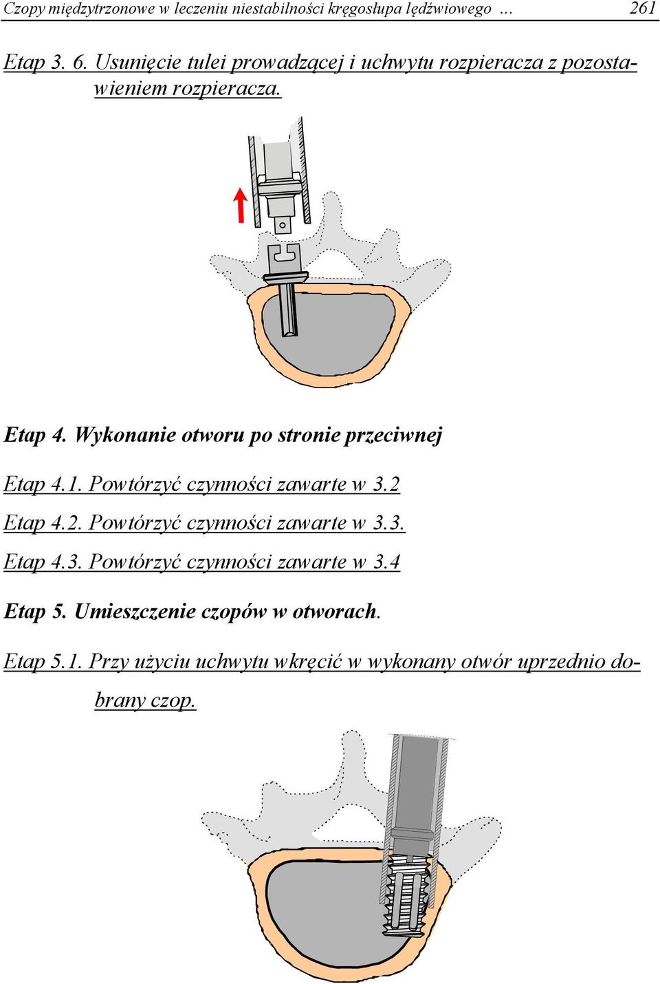 Wykonanie otworu po stronie przeciwnej Etap 4.1. Powtórzyć czynności zawarte w 3.2 Etap 4.2. Powtórzyć czynności zawarte w 3.3. Etap 4.3. Powtórzyć czynności zawarte w 3.4 Etap 5.