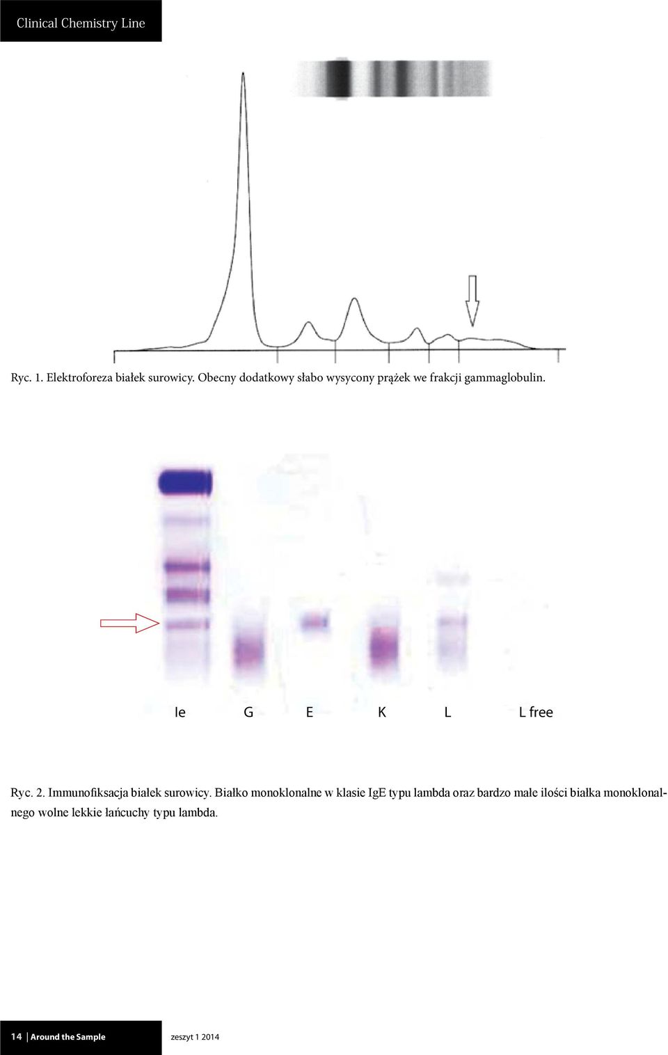 Ie G E K L L free Ryc. 2. Immunofiksacja białek surowicy.