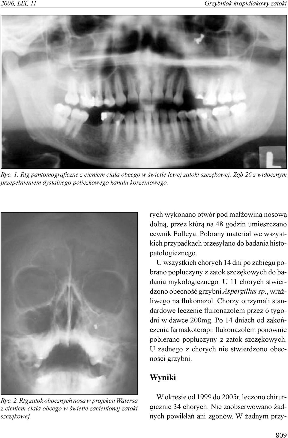 U wszystkich chorych 14 dni po zabiegu pobrano popłuczyny z zatok szczękowych do badania mykologicznego. U 11 chorych stwierdzono obecność grzybni Aspergillus sp., wrażliwego na flukonazol.