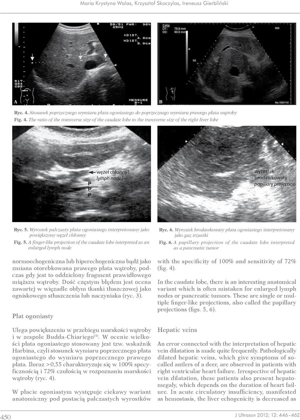 A finger-like projection of the caudate lobe interpreted as an enlarged lymph node normoechogeniczna lub hiperechogeniczna bądź jako zmiana otorebkowana prawego płata wątroby, podczas gdy jest to