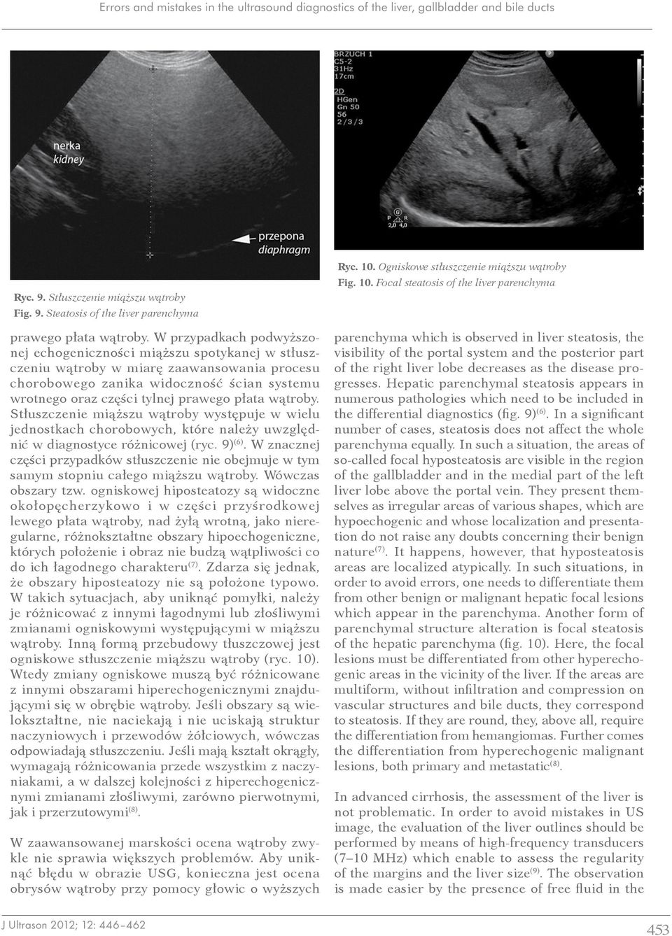 płata wątroby. Stłuszczenie miąższu wątroby występuje w wielu jednostkach chorobowych, które należy uwzględnić w diagnostyce różnicowej (ryc. 9) (6).