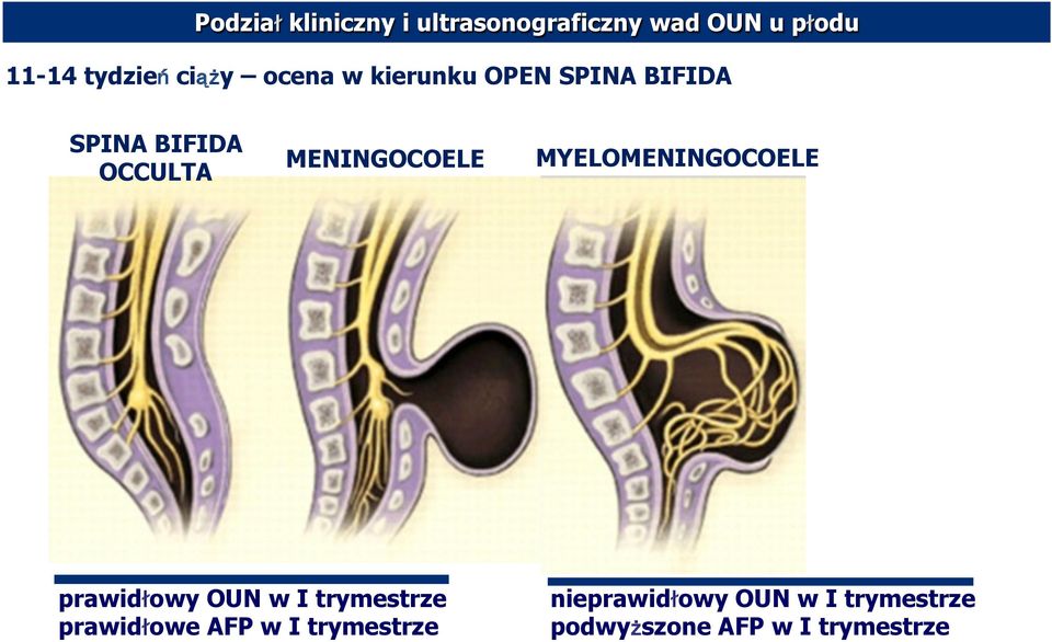 MENINGOCOELE MYELOMENINGOCOELE prawidłowy OUN w I trymestrze prawidłowe