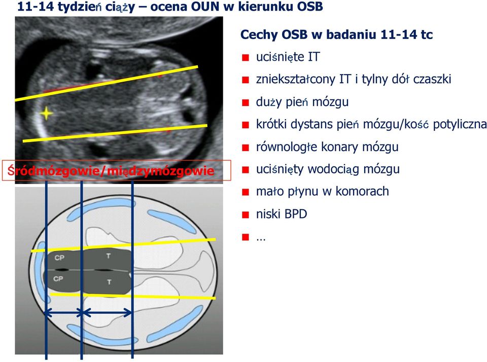 czaszki duży pień mózgu krótki dystans pień mózgu/kość potyliczna