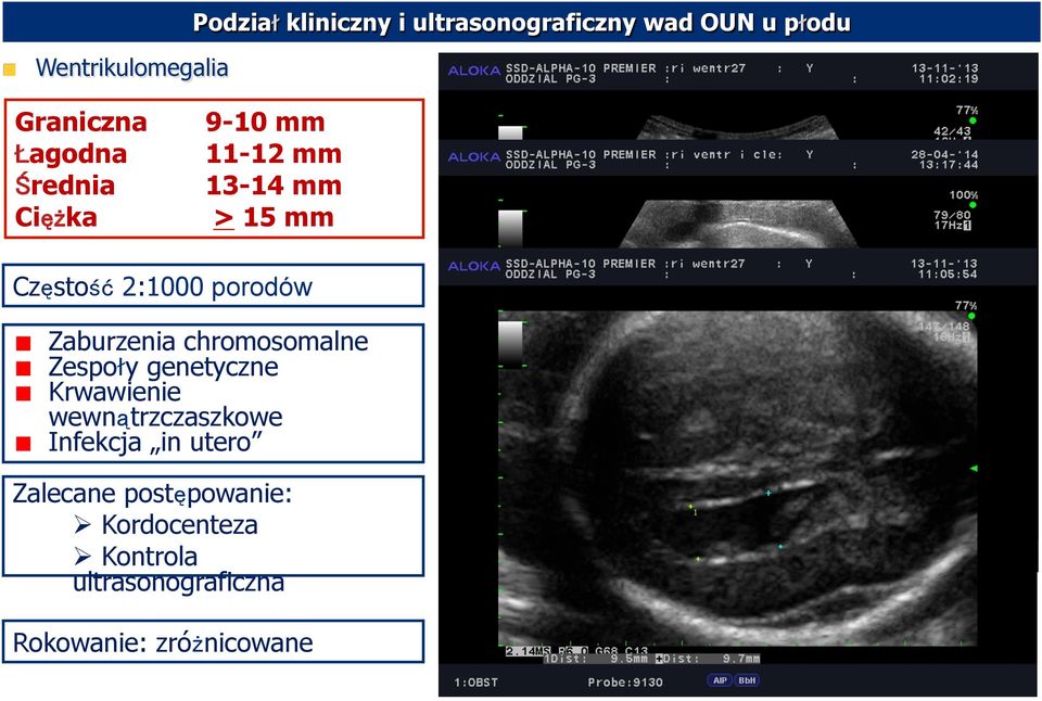 wad OUN u płodu Zaburzenia chromosomalne Zespoły genetyczne Krwawienie