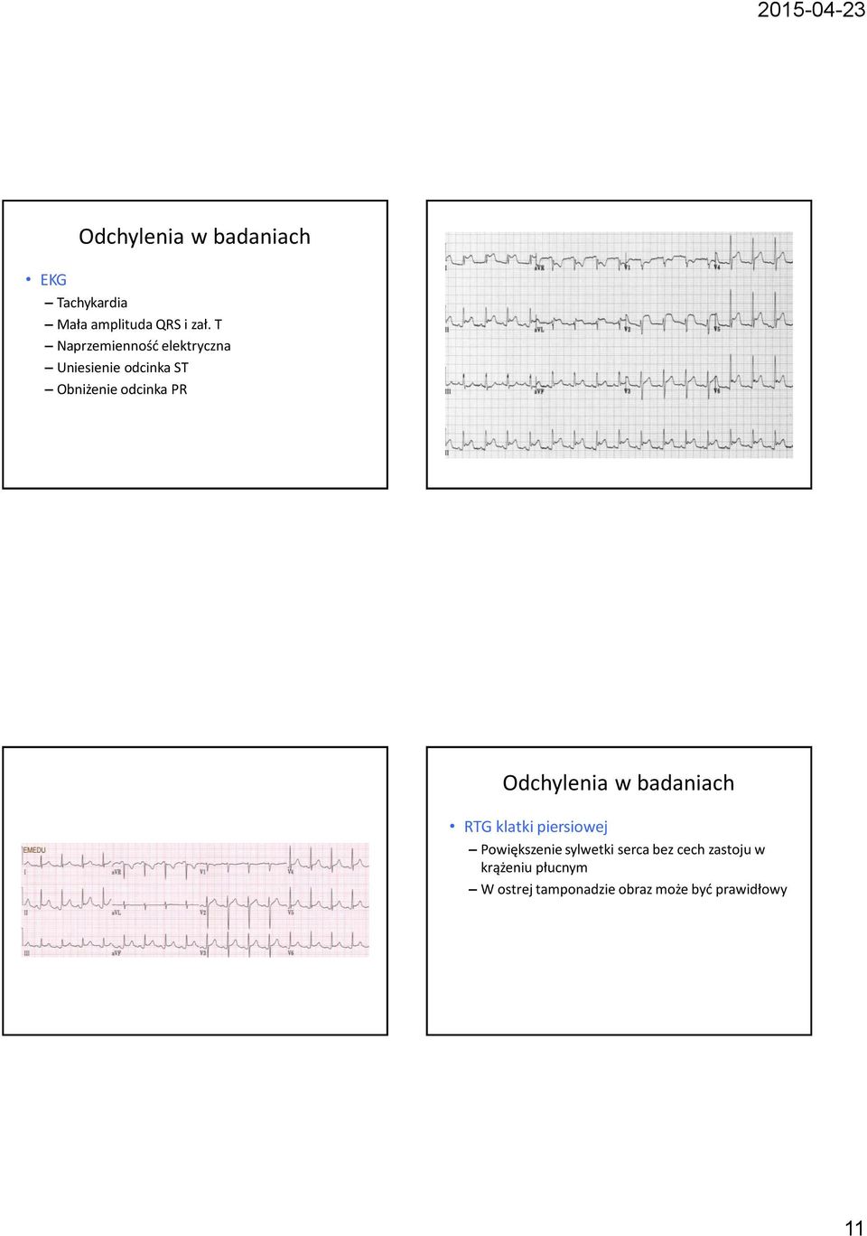 Odchylenia w badaniach RTG klatki piersiowej Powiększenie sylwetki serca