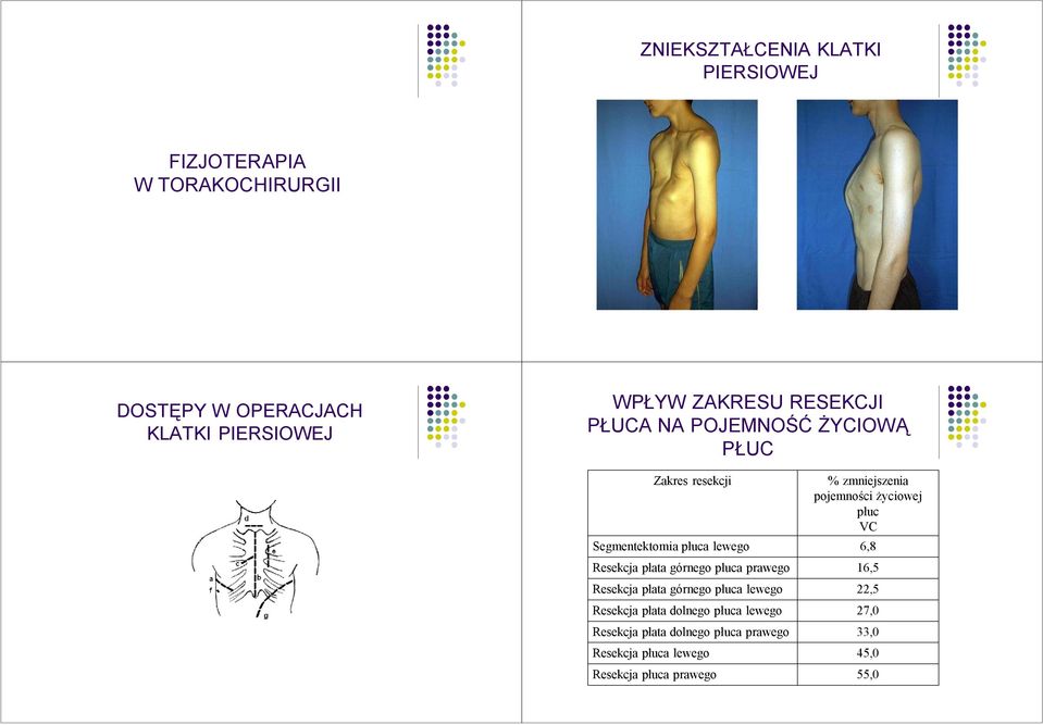 płuca prawego Resekcja płata górnego płuca lewego Resekcja płata dolnego płuca lewego Resekcja płata dolnego płuca