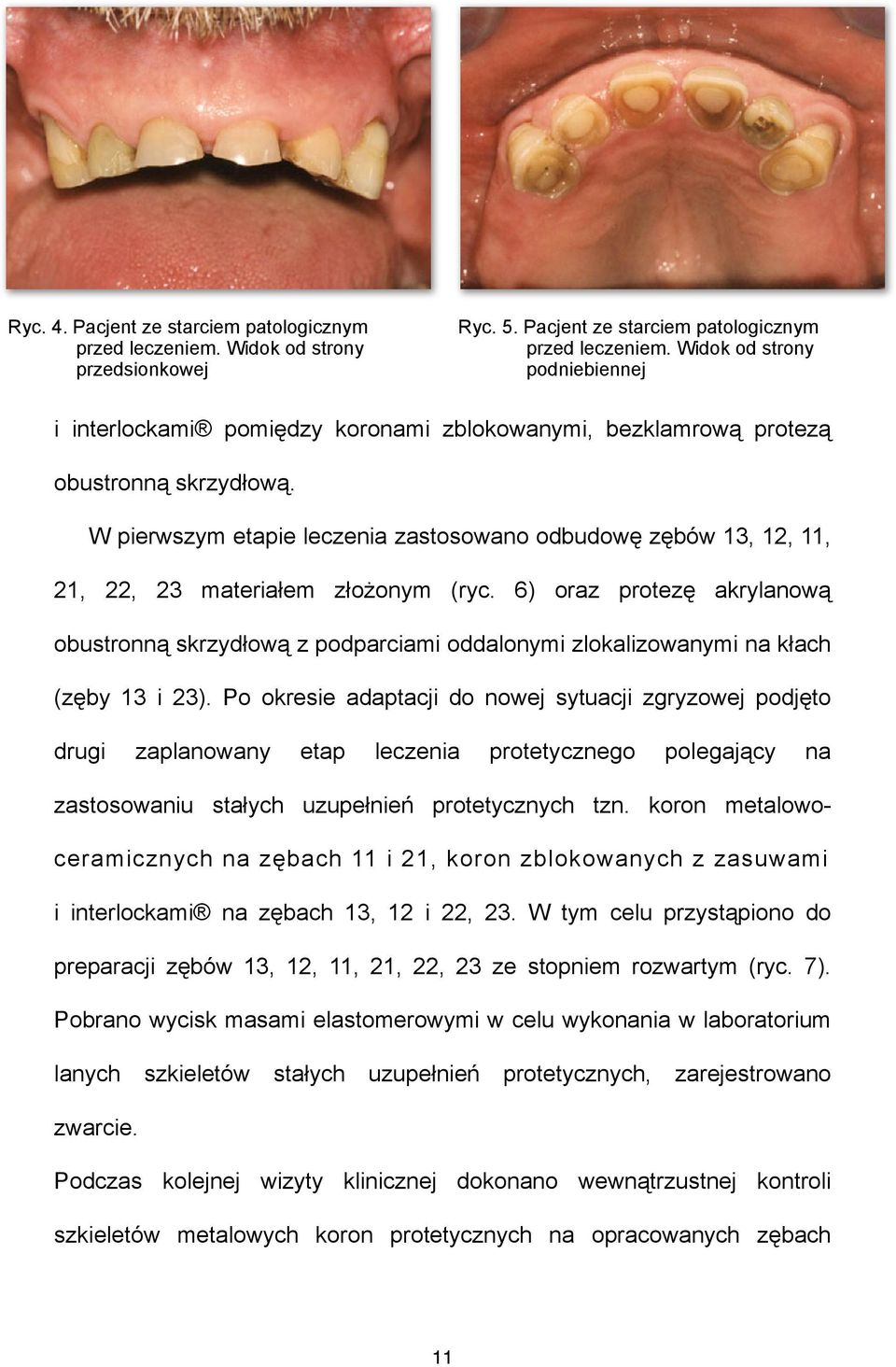 6) oraz protezę akrylanową obustronną skrzydłową z podparciami oddalonymi zlokalizowanymi na kłach (zęby 13 i 23).