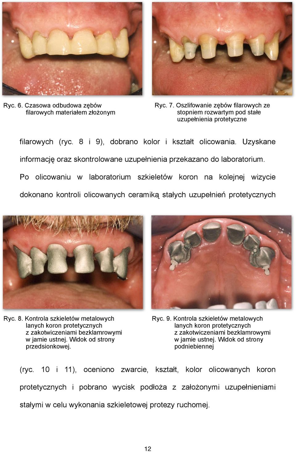 Po olicowaniu w laboratorium szkieletów koron na kolejnej wizycie dokonano kontroli olicowanych ceramiką stałych uzupełnień protetycznych Ryc. 8.