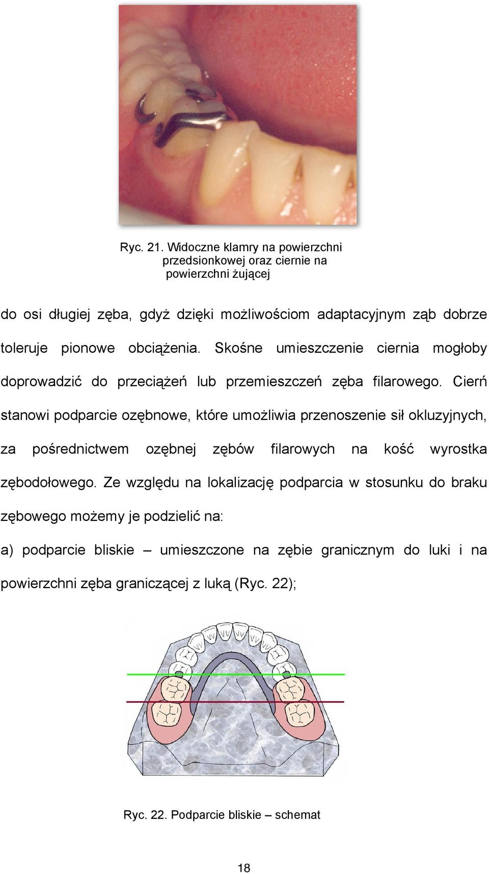 obciążenia. Skośne umieszczenie ciernia mogłoby doprowadzić do przeciążeń lub przemieszczeń zęba filarowego.